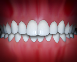_Overbite