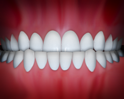 _Underbite