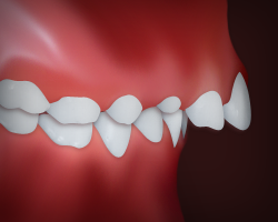 _UpperFrontTeethProtrusion